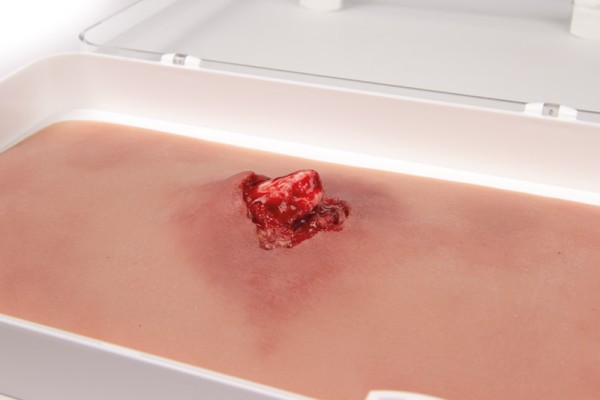 Offener Bruch Arm, mit Blutungsfunktion